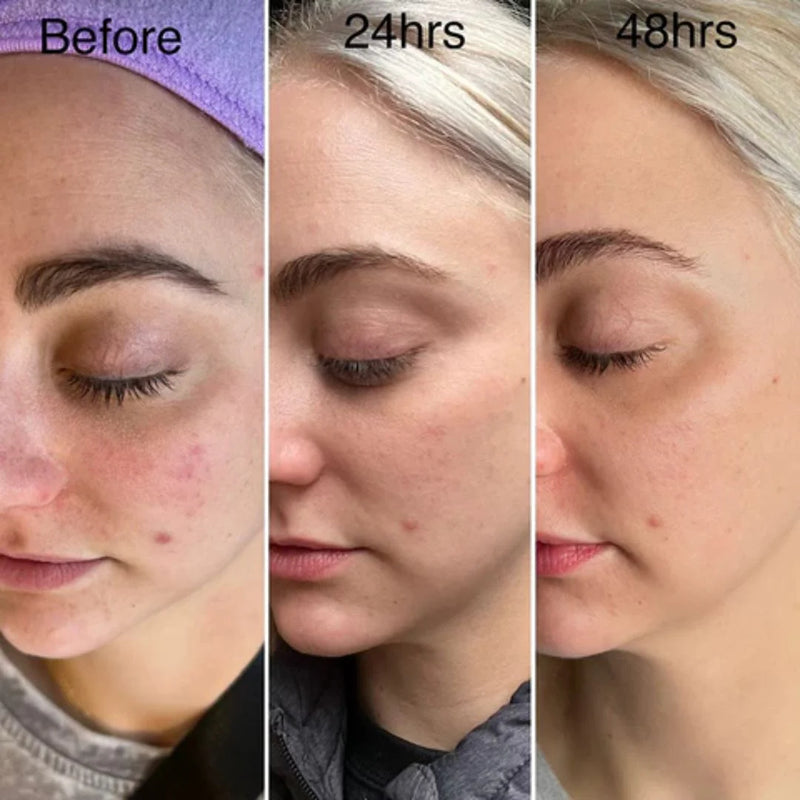 Nuvio High Frequency Acne Wand