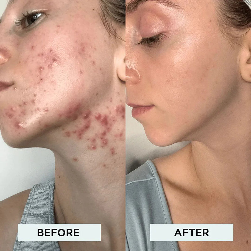 Nuvio High Frequency Acne Wand